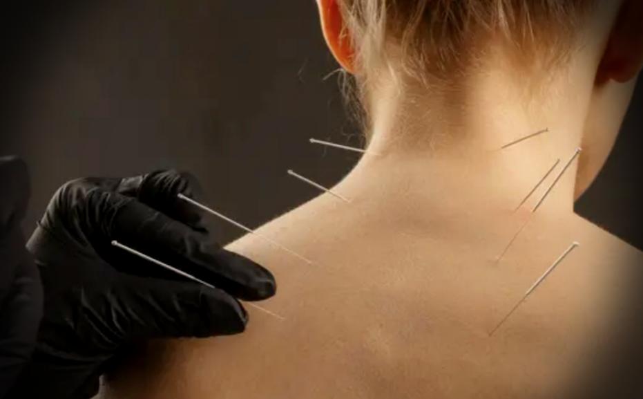 Βελονισμός / Dry Needling